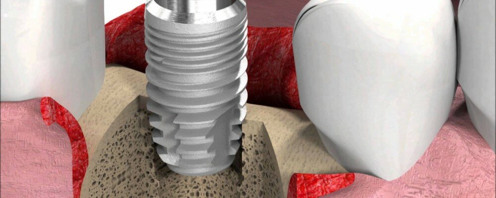 Verbesserung von Zahnimplantaten
